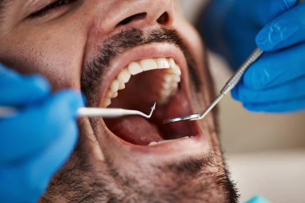 Best Emergency Tooth Extraction in Dresser, WI