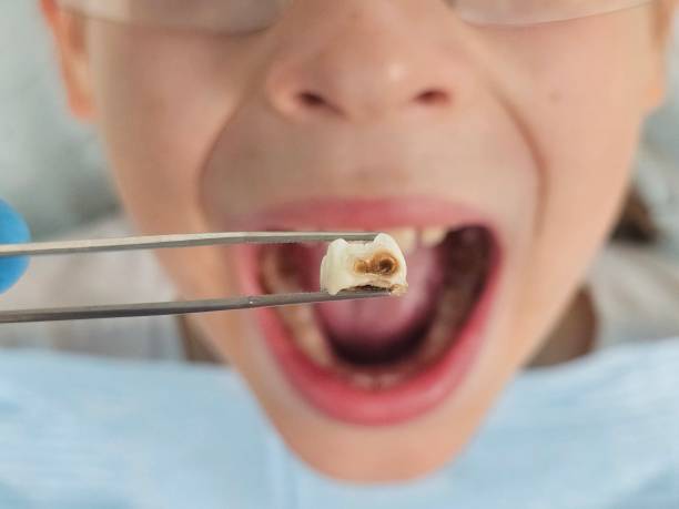 Best Emergency Dental Care for Broken or Chipped Teeth in Dresser, WI